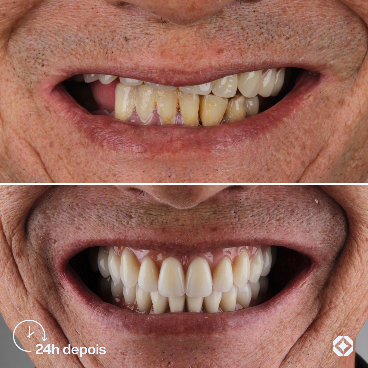 Antes e depois de implante dentário - caso 1