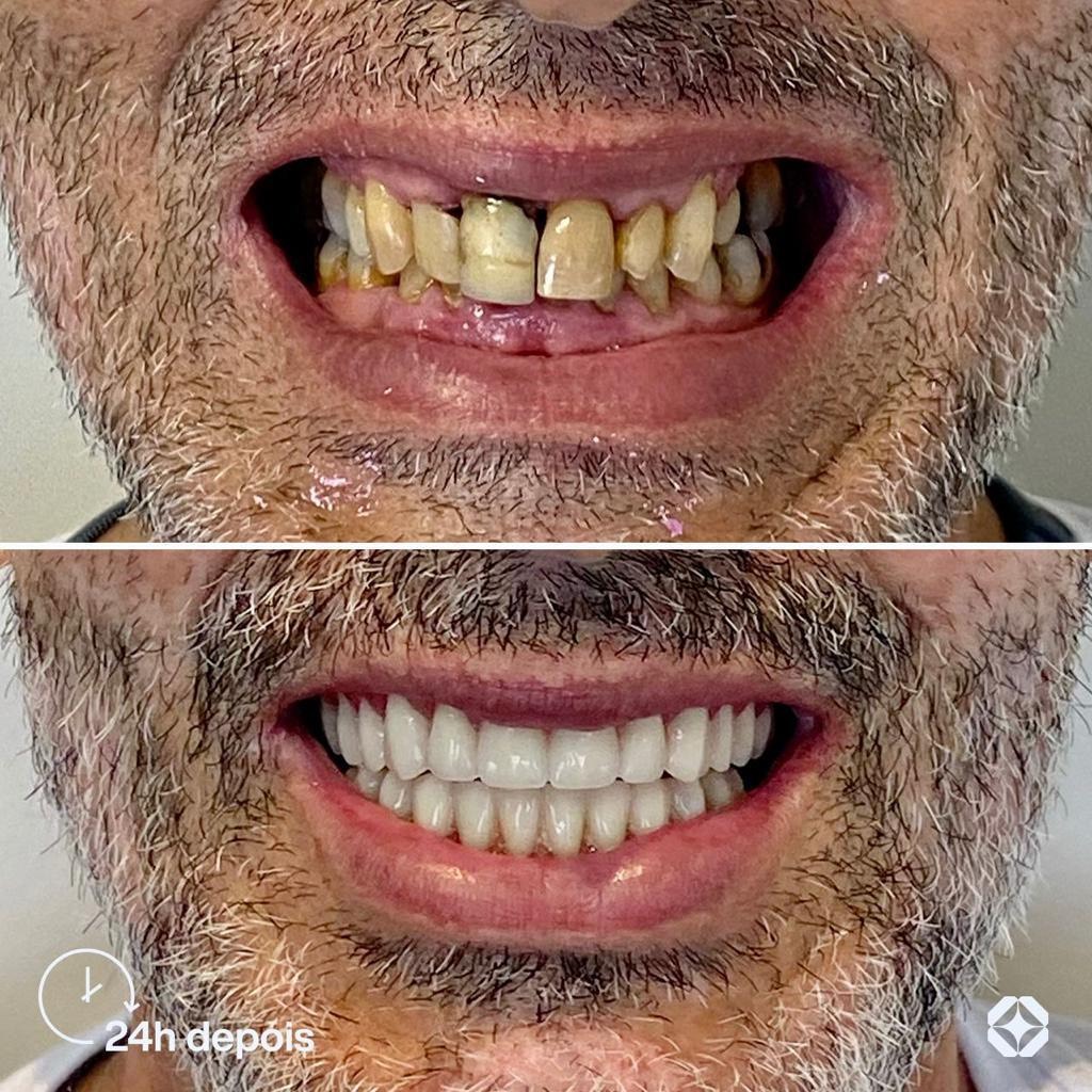 Antes e depois de implante dentário - caso 10