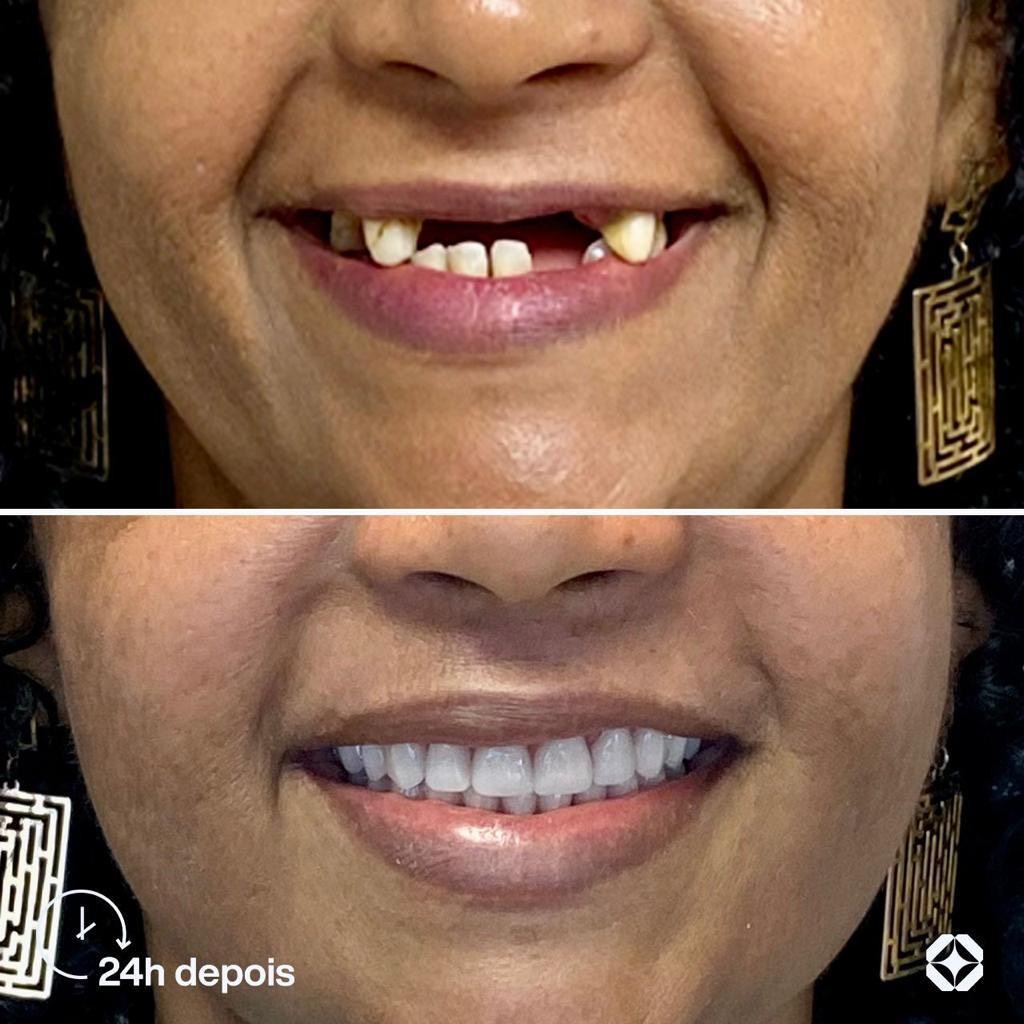 Antes e depois de implante dentário - caso 11