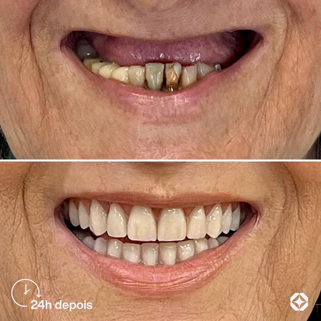 Antes e depois de implante dentário - caso 12