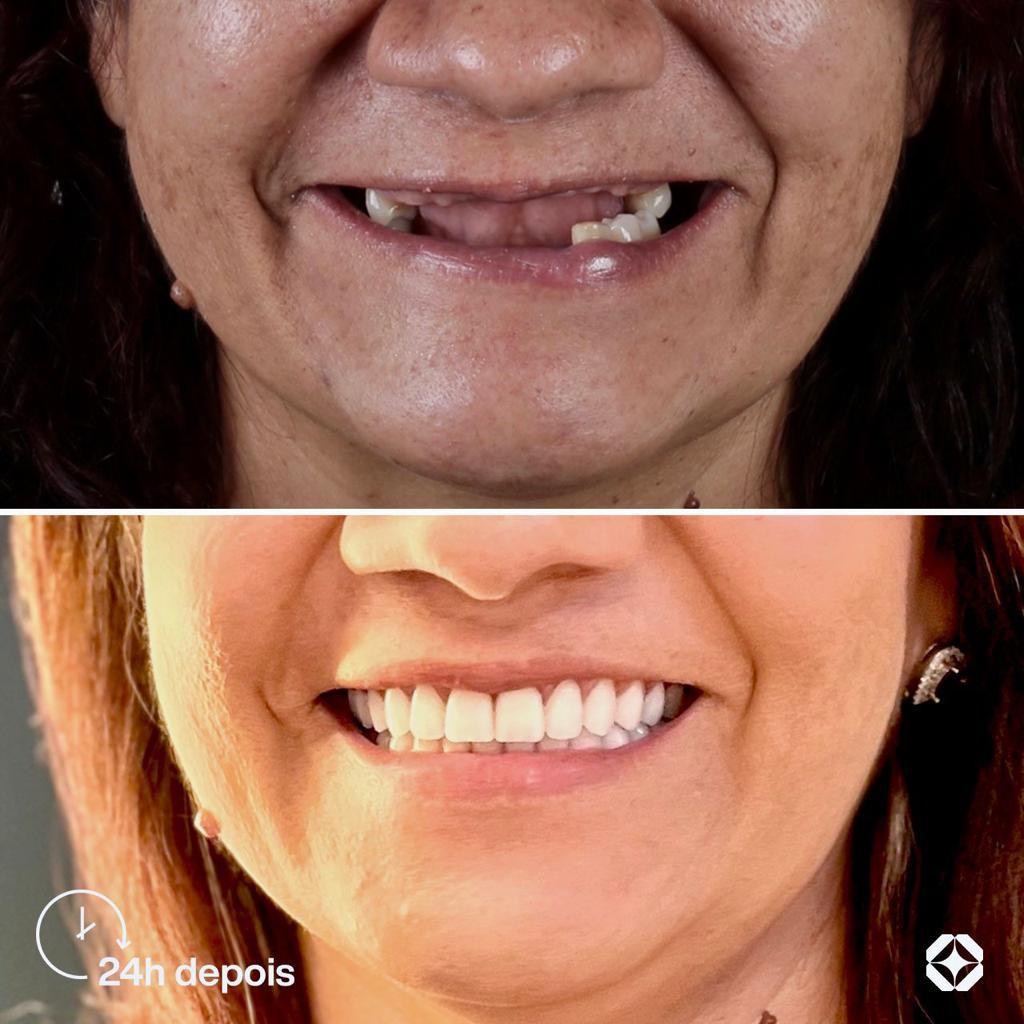 Antes e depois de implante dentário - caso 13