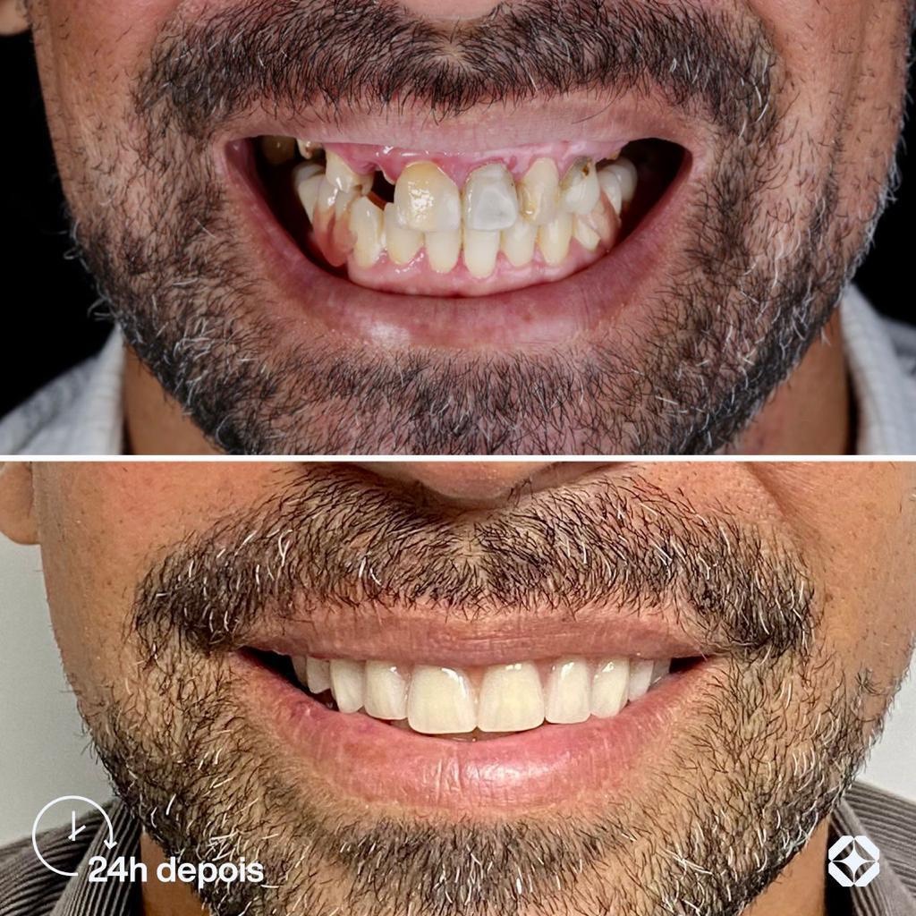Antes e depois de implante dentário - caso 14