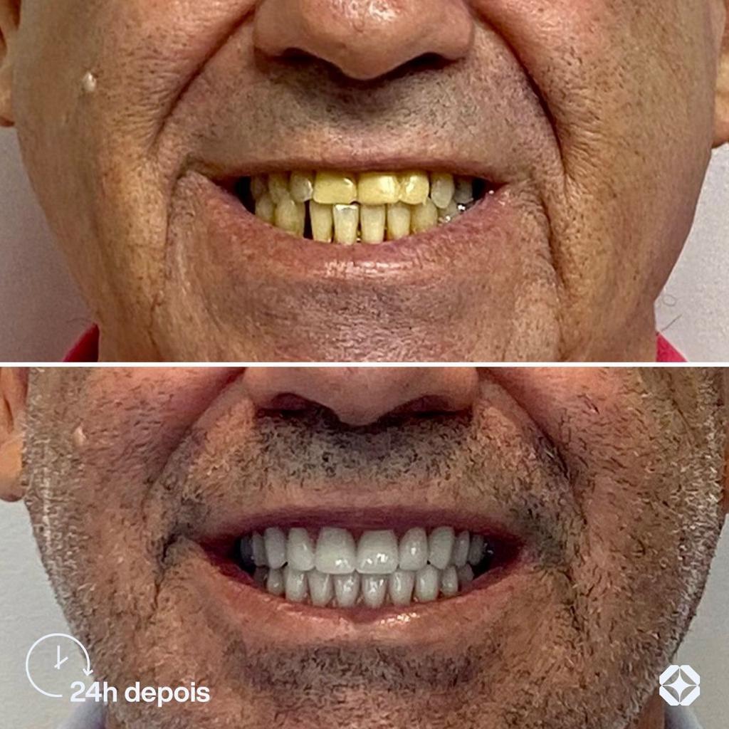 Antes e depois de implante dentário - caso 15