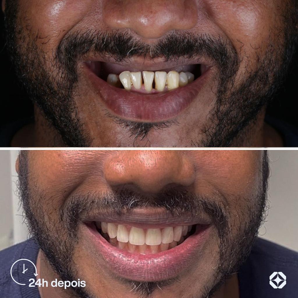 Antes e depois de implante dentário - caso 16