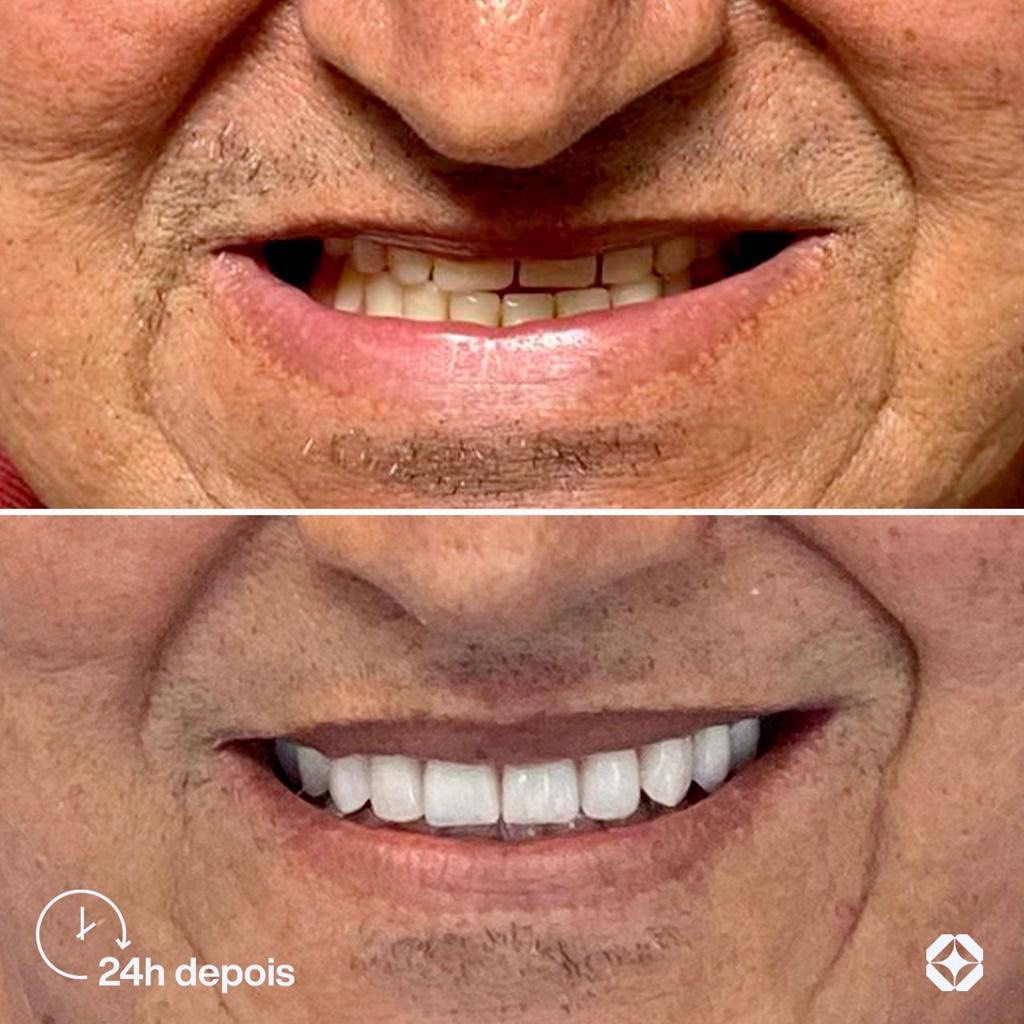 Antes e depois de implante dentário - caso 17