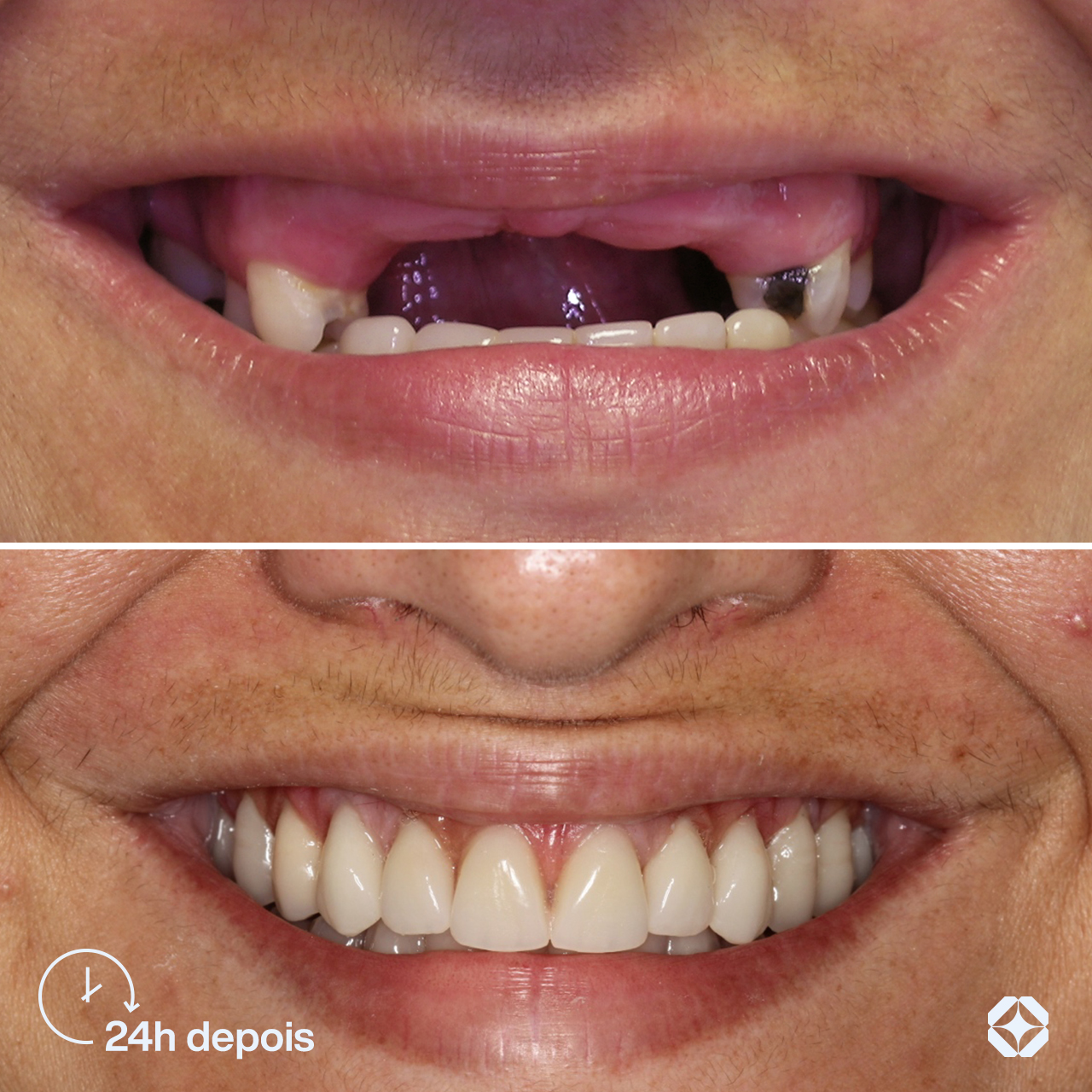 Antes e depois de implante dentário - caso 2