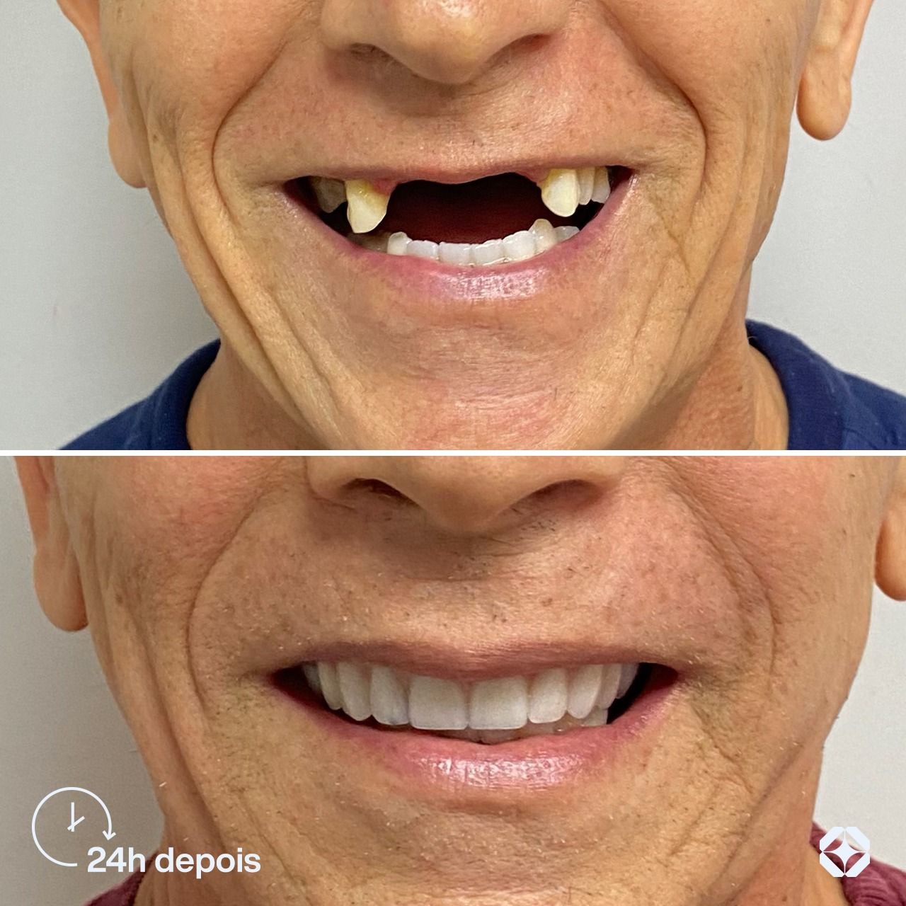 Antes e depois de implante dentário - caso 18