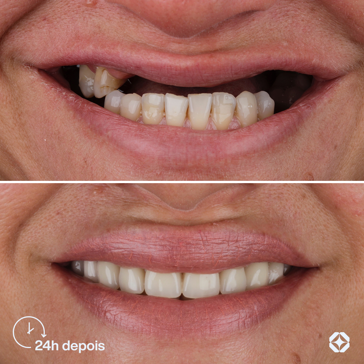 Antes e depois de implante dentário - caso 3