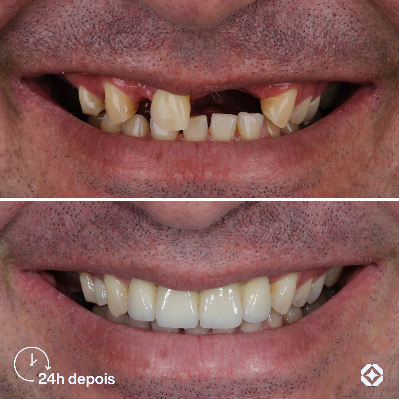 Antes e depois de implante dentário - caso 4