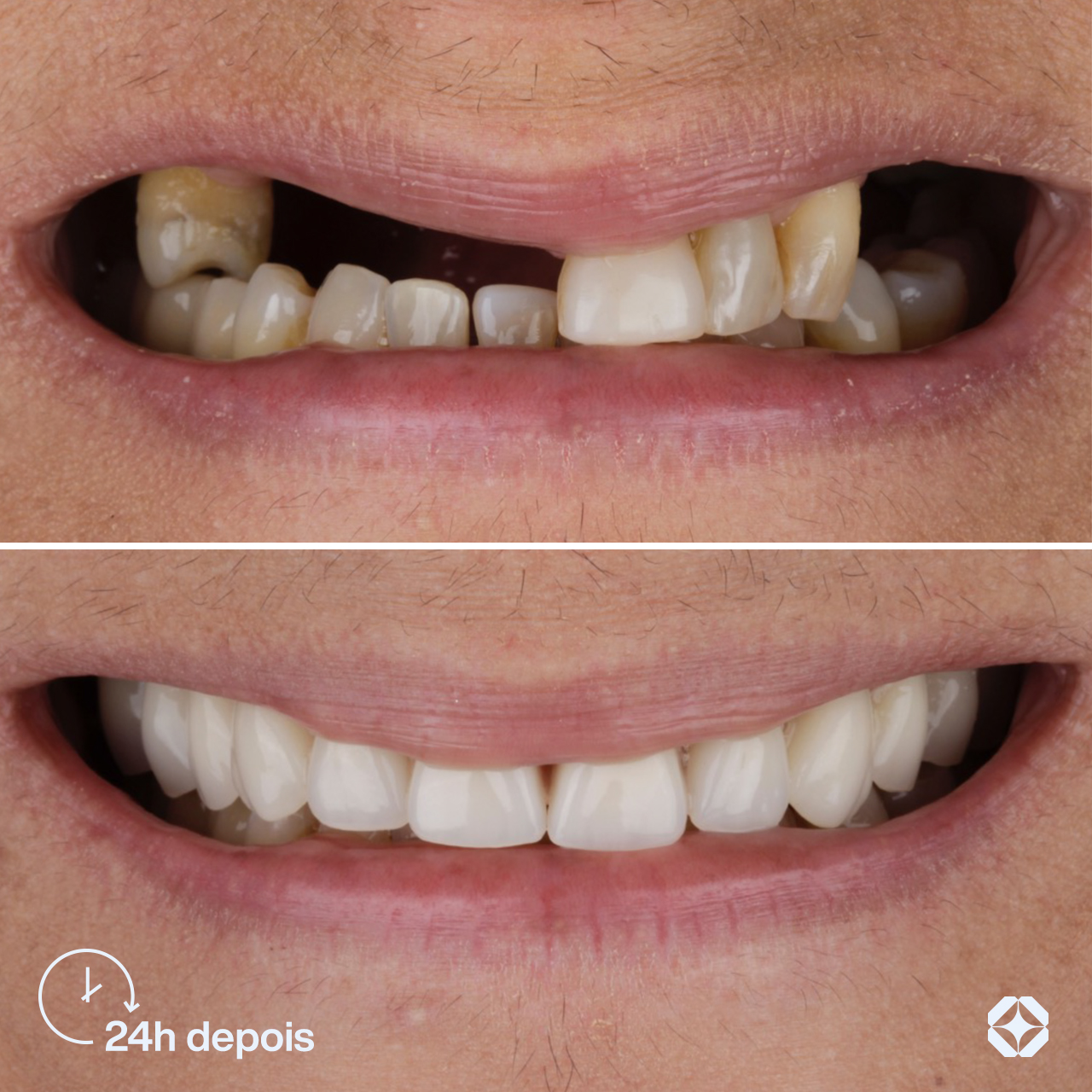 Antes e depois de implante dentário - caso 5
