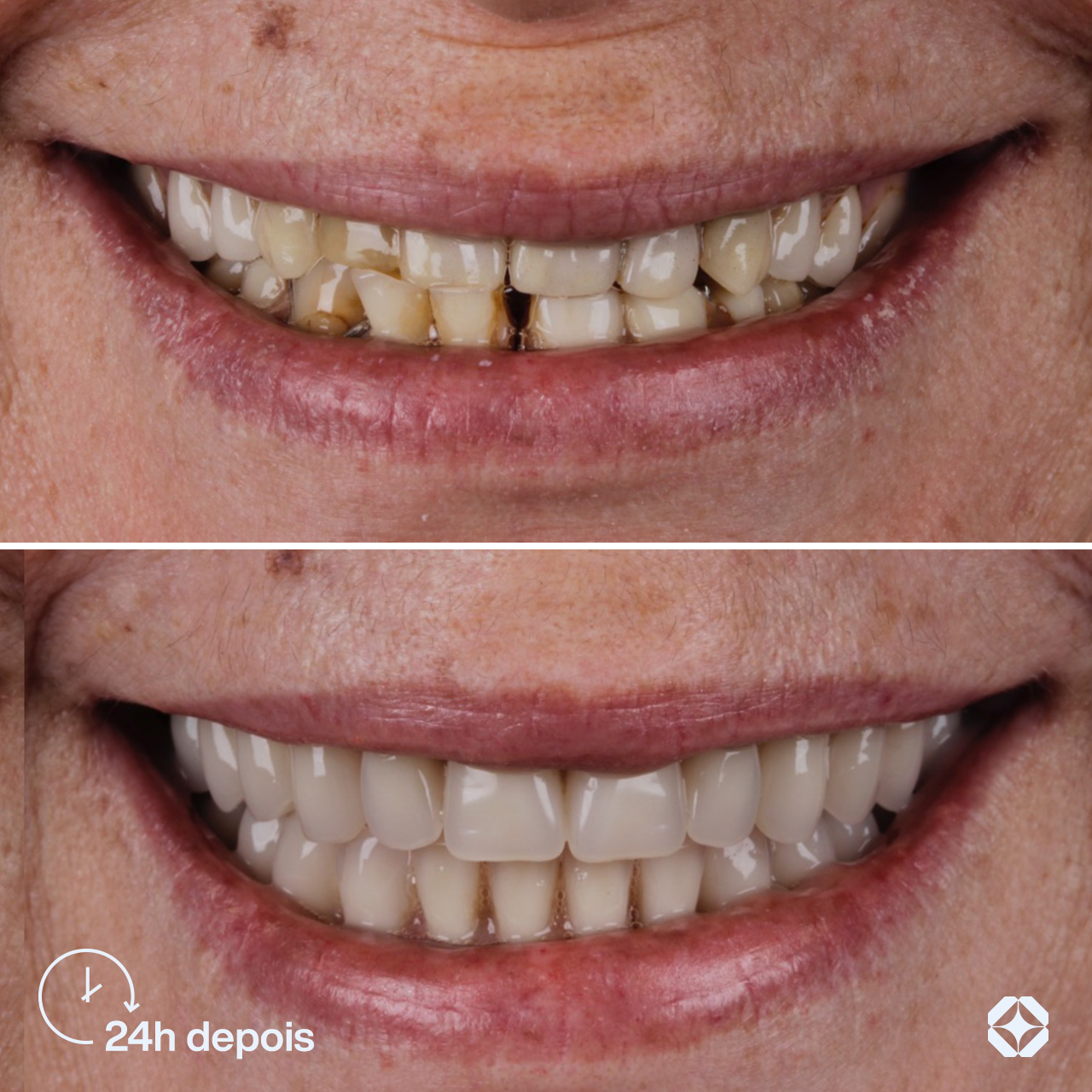 Antes e depois de implante dentário - caso 6