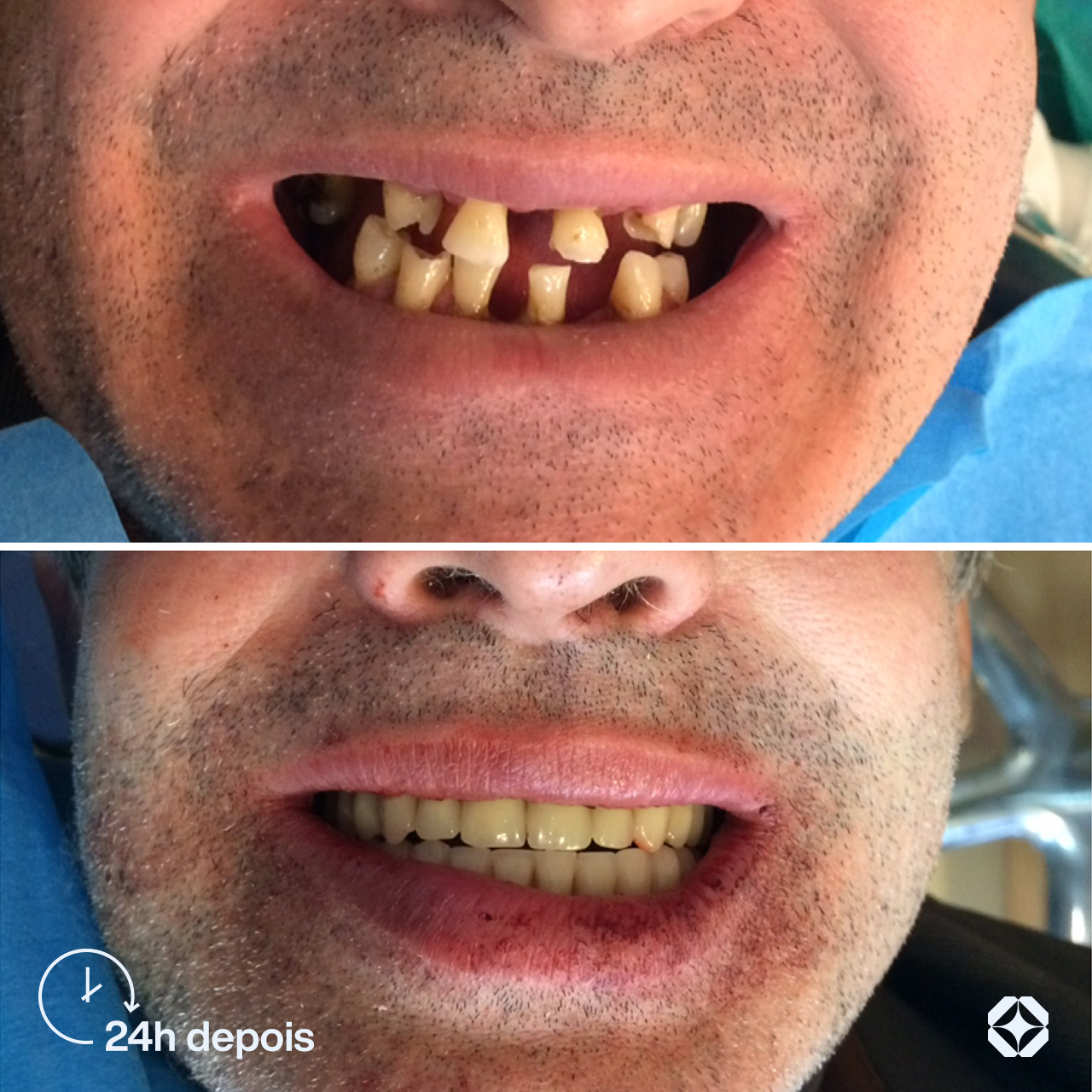 Antes e depois de implante dentário - caso 7
