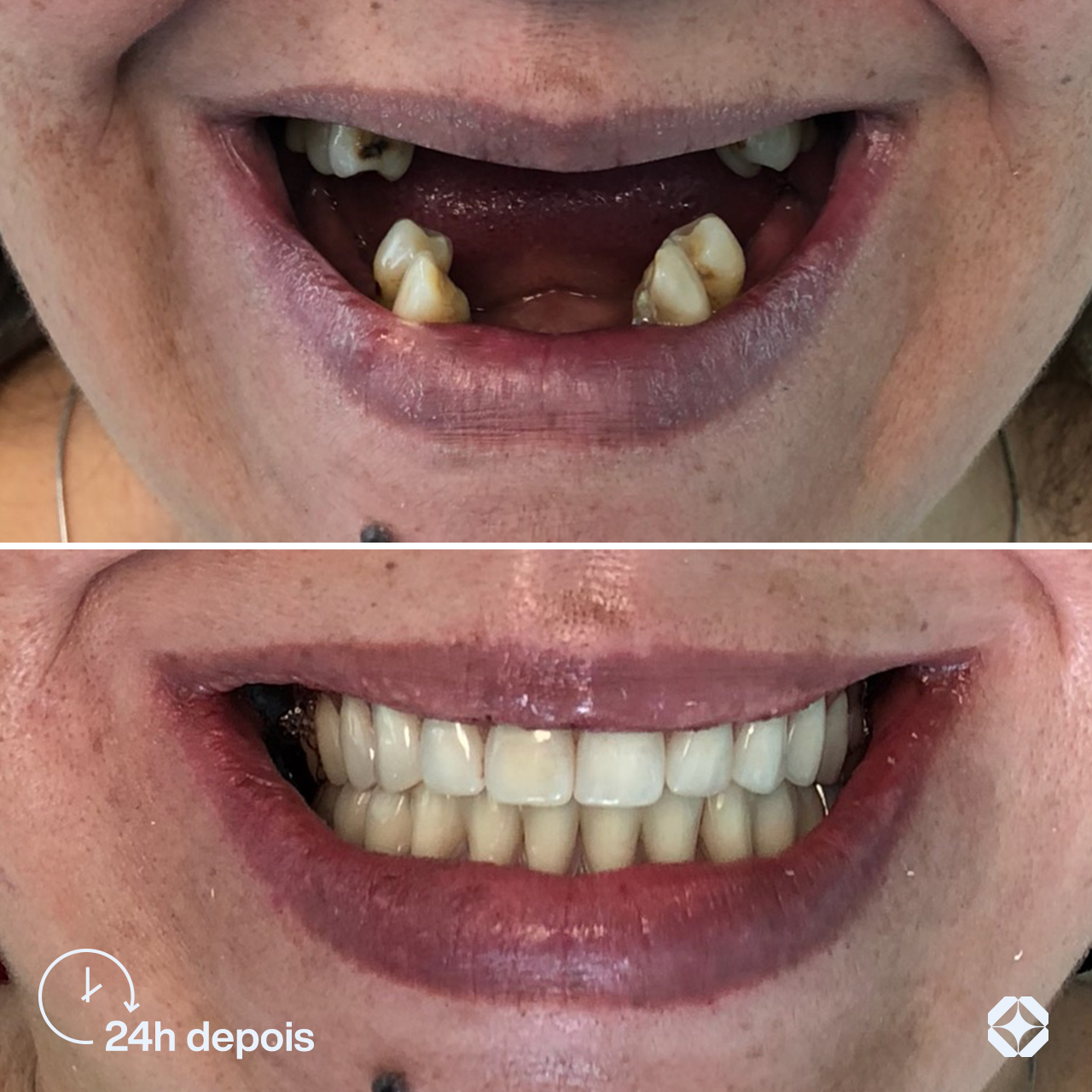 Antes e depois de implante dentário - caso 8