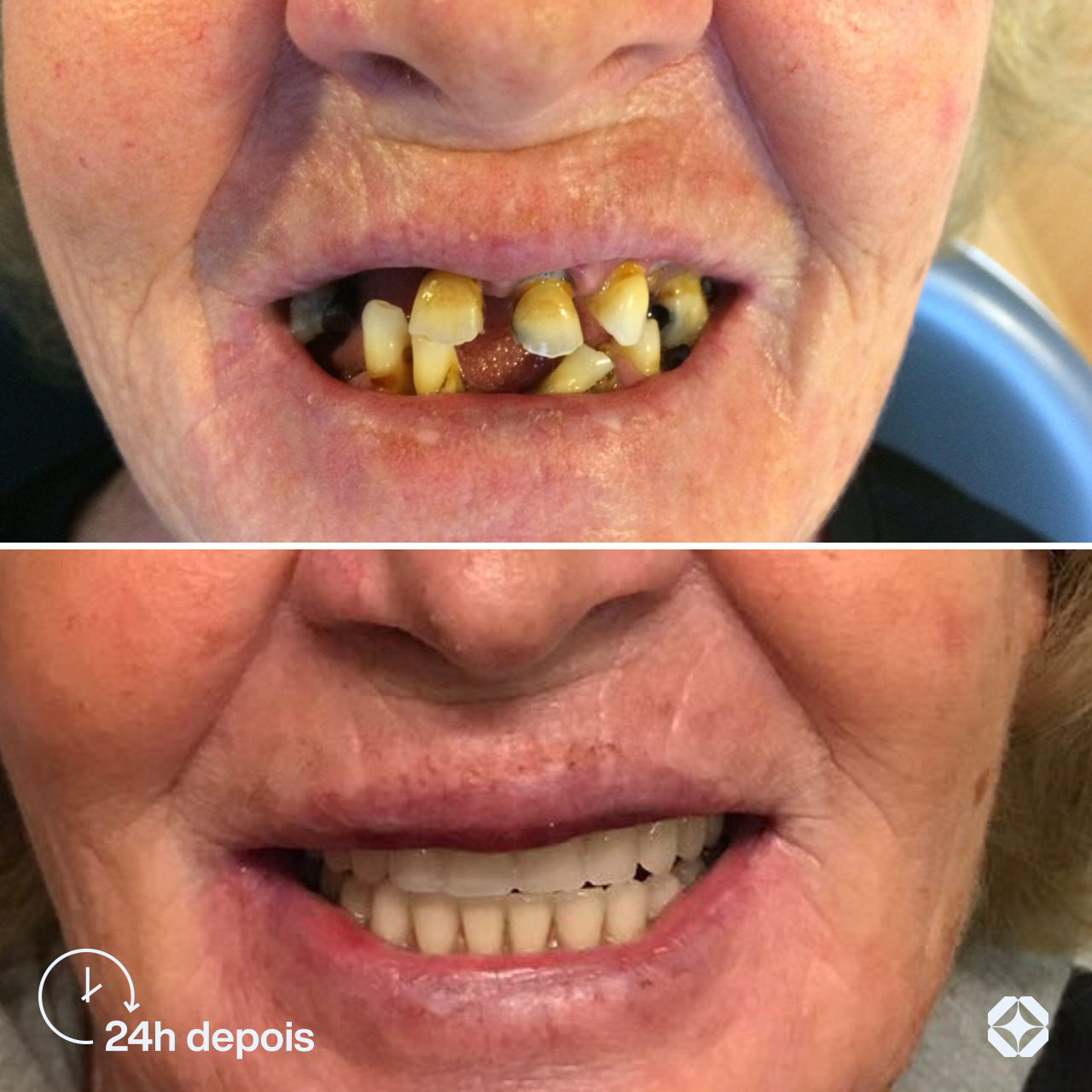 Antes e depois de implante dentário - caso 9